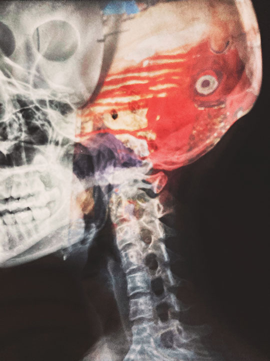 head and neck injury x-ray